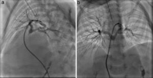 (a) LAO projection: selective angiography of a PDA can be seen; confluent pulmonary branches are perfused by the PDA. (b) PA projection: angiography in the PDA observing confluent and hypoplastic pulmonary branches with severe stenosis in the joining site with left pulmonary branch.