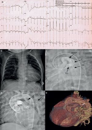1a) Electrocardiograma que muestra crecimiento de cavidades derechas; 1b) Radiografía de tórax que muestra RDAP dilatada; 1c) Angiografía que revela el nacimiento de la RDAP del TCI; 1d) Nacimiento de la RIAP desde CA, y 1e) Reconstrucción tridimensional de tomografía de tórax que evidencia el nacimiento de las ramas pulmonares.