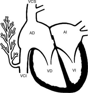 Esquema frontal de un corazón que muestra la conexión anómala de las venas del pulmón derecho a la porción suprahepática de la vena cava inferior. AD: aurícula derecha; AI: aurícula izquierda; VCI: vena cava inferior; VCS: vena cava superior; VD: ventrículo derecho; VI: ventrículo izquierdo.