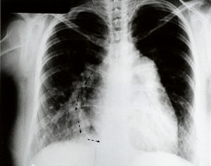 Radiografía de tórax de un caso con síndrome de la cimitarra. Obsérvese en el hemotórax derecho el trayecto curvo del colector venoso (flechas).