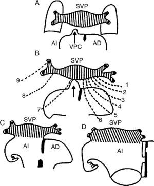 Esquemas que muestran la conexión venosa pulmonar secundaria con la aurícula izquierda a través de la vena pulmonar común. A) Acercamiento de la vena pulmonar común con el seno venoso pulmonar. B) Conexión de la vena pulmonar común (flecha) con el seno venoso pulmonar; obsérvese la atresia de los colectores primitivos de la conexión venosa pulmonar primaria (líneas discontinuas). C y D) Incorporación del seno venoso pulmonar al techo de la aurícula izquierda. AD: aurícula derecha; AI: aurícula izquierda; SVP: seno de las venas pulmonares; VPC: vena pulmonar común; 1: colector hacia la futura vena cava superior; 2: colector hacia el cayado de la vena ácigos; 3: colector hacia la vena cava superior; 4: colector hacia la porción sinusal de la aurícula derecha; 5: colector hacia la porción suprahepática de la vena cava inferior; 6: colector hacia la vena porta; 7: colector hacia el conducto venoso; 8: colector hacia el seno venoso coronario; 9: colector hacia la vena vertical.