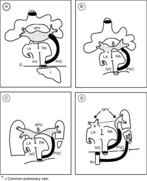 Esquemas que ilustran la hipótesis sobre la morfogénesis de la conexión venosa pulmonar del síndrome de la cimitarra. A) Muestra la persistencia del colector que une el seno de las venas pulmonares con la porción suprahepática de la vena cava inferior y el inicio de la conexión entre dicho seno y la aurícula izquierda. B y C) Muestran la separación del seno venoso pulmonar. D) El seno venoso pulmonar queda separado en 2 porciones, la izquierda se conecta a la aurícula izquierda y la derecha se continúa con el colector venoso pulmonar curvo. AD: aurícula derecha; AI: aurícula izquierda; Ao: aorta; CVP: colector venoso pulmonar; D: diafragma;H: hígado; SVP: seno de las venas pulmonares; VCI: vena cava inferior.fbibl