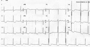 Fibrilación auricular con frecuencia ventricular media de 60-70 lpm, con datos de hipertrofia de ventrículo izquierdo (índice de Sokolow de 84mm y de Cornell de 42mm) y de sobrecarga sistólica del mismo (desnivel negativo descendente del segmento S-T e inversión asimétrica de las ondas T en DII, DIII, AVF y de V3 a V6).