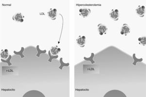 Representación esquemática de la captura de LDL por los receptores específicos localizados transmembranalmente en el hepatocito en condiciones normales (lado izquierdo). En el lado derecho se nota una reducción importante del receptor, lo cual causa un exceso circulante de colesterol, debido a que el colesterol no es degradado por permanecer en la circulación.