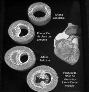 Representación esquemática del ateroma hasta que se presenta la rotura de la placa y la trombosis.