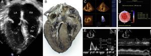 (A) Two-dimensional transthoracic study showing symmetric thickening of the left ventricular walls and granular sparkling of the interventricular septum. (B) Anatomic specimen with a very good correlation with the echocardiographic image in A. (C) 3D echo with normal left ventricular ejection fraction. (D) Diminished left ventricular longitudinal deformation. (E) Left ventricular diastolic disfunction type III. (F) Mildly depressed right ventricular systolic dysfunction.