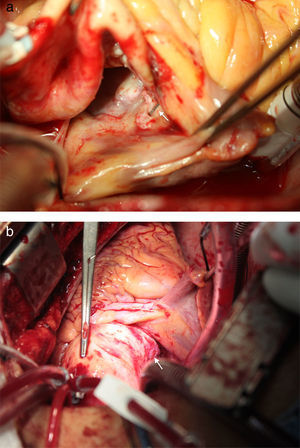 a) Dispositivo Amplatzer® extruido sobre el techo de la aurícula derecha con rotura de la pared de la misma. b). Aorta ascendente parcialmente lacerada a nivel del seno no coronario por dispositivo Amplatzer®.