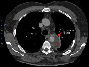 Estudio inicial en el corte axial de 3mm de la tomografía computarizada multicorte de tórax, donde se observa una colección hipodensa adyacente a la aorta descendente a nivel del istmo de la aorta (flecha roja) con medidas de 8,3×4,5cm y con un coeficiente de atenuación de 20UH.