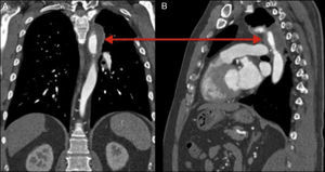 Imágenes de la tomografía computarizada multicorte en reconstrucciones de 1,5mm en los planos coronal (A) y sagital (B), donde se observa la colección adyacente a la aorta descendente a nivel del istmo de la aorta (doble cabeza de flecha).