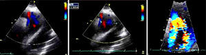 Axis suprasternal echocardiogram, aortic arch and descending aorta is observed, with double-lumen image.