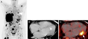 Mujer de 58 años con linfoma no Hodgkin gástrico con afección sistémica (nodal y extranodal), como se observa en la imagen coronal en máxima intensidad de proyección de PET con 18FDG (A). La imagen tomográfica en eje 4 cámaras del PET-CT muestra una zona focal de engrosamiento del tercio medio de la pared libre del ventrículo izquierdo, isodensa al miocardio (flecha en B) y que en las imágenes de fusión presenta aumento en la actividad metabólica (C). (Cortesía del Dr. Jose Luis Criales/CT Scanner).