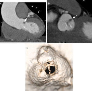 Mujer de 93 años con imagen sugestiva de fibroelastoma, como hallazgo incidental. Imágenes de TC en cortes coronal (A), axial (B) y reconstrucción en 3D con navegación endovascular (C), donde se observa pequeña imagen nodular de 2mm aproximadamente, a nivel de una de las comisuras valvulares de la aorta (flechas).