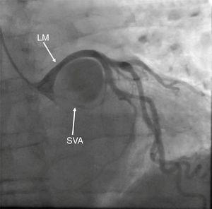 Coronary angiography showing left main extrinsic compression from an ovoid-shaped structure with turbulent flow of dye inside (LM – left main coronary artery; SVA – sinus of Valsalva aneurysm).