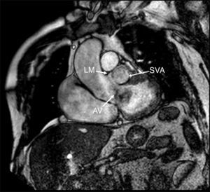 Magnetic resonance imaging confirming the presence of a left Valsalva sinus unruptured aneurysm below the left main, causing extrinsic compression (LM – left main coronary artery; SVA – sinus of Valsalva aneurysm; AV – aortic valve).