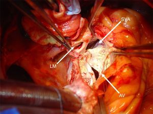 Operative findings revealing a 2.5cm diameter left aortic sinus aneurysm, just below the left main (LM – left main coronary artery; SVA – sinus of Valsalva aneurysm; AV – aortic valve).