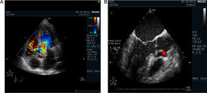 A) Imagen de ETT con Doppler color de la comunicación interventricular. B) vegetación (flecha) sobre la válvula aórtica en ETE.