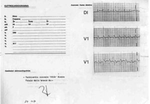 Derivaciones DI y V1 del primer paciente diagnosticado con el síndrome de muerte súbita, asociada a una morfología electrocardiográfica similar al bloqueo de rama derecha y elevación del segmento ST. Fue tomado poco después de un paro cardiaco reanimado mediante desfibrilación el 20 de noviembre de 1984. Es interesante que el cardiólogo lo interpretó como «taquicardia sinusal a 120lpm y bloqueo focal de rama derecha».