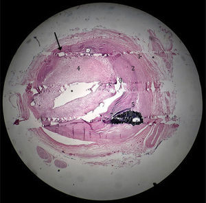 Fotomicrografía de arteria coronaria posterior a la electrodeposición. Se observa el espacio previamente ocupado por strut de stent (flecha), las 3 capas de la arteria de afuera hacia adentro, túnica adventicia (1), túnica media (2), túnica íntima con placa fibroesclerótica (3), proliferación extensa de capa neointimal (4) que ocluye la luz del vaso (*). Calcificación de placa esclerótica (5) (H&E ×2.5).