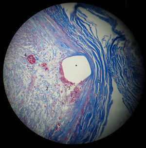 Fotomicrografía de arteria coronaria posterior a la electrodeposición que muestra el espacio que ocupaba el stent (*). Periféricamente hay gruesas fibras de colágena en color azul fuerte (1). Centralmente hay miofibroblastos (2) en una matriz de delgadas fibras de colágena (azul claro). Hay células gigantes multinucleadas (3) de reacción a cuerpo extraño en la periferia del stent (color rojo). Presencia de pequeños vasos de neoformación (4) (Masson ×40).