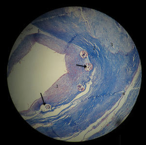 Fotomicrografía de pared arterial coronaria posterior a la electrodeposición, observe los espacios con remanentes de stent (flecha). Hacía la luz del vaso la proliferación de la neoíntima (1). Periféricamente se observa placa ateromatosa esclerótica (2) con área de necrosis (3). La capa muscular está atrófica y extremadamente adelgazada (4) (Masson ×2.5).