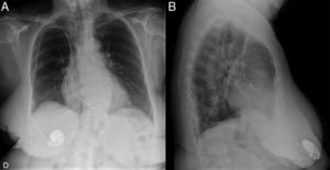 Radiografía de tórax en proyecciones anteroposterior (A) y lateral (B), donde se objetiva el generador del marcapasos en zona de la mama derecha.