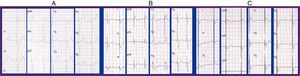 A) Fibrilación auricular con ritmo ventricular estimulado desde ápex de VD. Morfología de QRS similar a BRIHH y eje izquierdo. QRS: 176ms. B) ECG estimulación biventricular. QRS: 166ms. C) ECG estimulación tri-ventricular. QRS: 155ms.