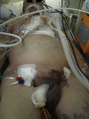 Picture taken in the Intensive Care Unit Just before transfer the patient to the operating room for a perineal debridement. Necrosis of the skin of the scrotum, pennies and part of the left groin is clearly appreciated. Finding consistent with the diagnosis of Fournier's gangrene.