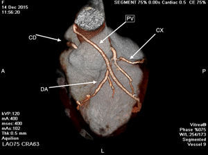 64 multislice computed tomography coronary angiography showing non-obstructive lesion in native coronary arteries, poor growth of LIMA and patency of the SVG to the obtuse marginal branch.