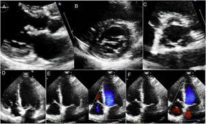 Transthoracic bidimensional echocardiographic study with nodular thickening in subvalvular apparatus and mitral valve leaflet (A,B), aortic valve (C) and tricuspid valve (D,E). Mild tricuspid regurgitation was found with color flow (E,F).