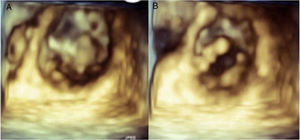 Transthoracic three-dimensional image of ventricular view of mitral valve in sistole (A) and diastole (B), showing nodular thickening in both leaflets.