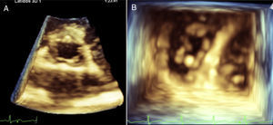 Transthoracic three-dimensional echocardiogram of the aortic valve with small nodules in the edges (A). Transthoracic three-dimensional ventricular view of the tricuspid valve in diastole, showing prominent nodules in their cusps (B).