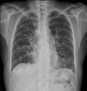 Chest radiograph showing cardiac silhouette of normal size and position, but with abnormal left profile and aorta unrolled. Interstitial lung bilateral thickening, reticulonodular parahiliar and basal pattern and bone changes (osteopenia).