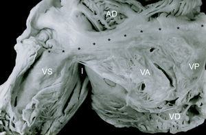 Vista interna de las cámaras derechas de un corazón con concordancia auriculoventricular y anomalía de Ebstein de la válvula tricúspide. El anillo fibroso está situado en la unión auriculoventricular (asteriscos). Obsérvese el adosamiento de las valvas septal y posterior a las paredes ventriculares, la valva anterior es redundante. AD: aurícula derecha; I: infundíbulo; VA: válvula anterior; VD: ventrículo derecho; VP: válvula posterior; VS: válvula septal.