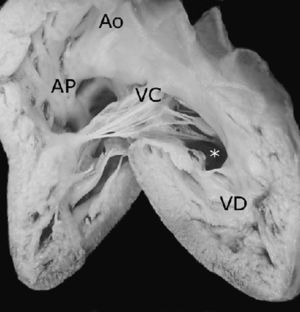 Vista interna del ventrículo derecho con doble entrada a esta cámara. Obsérvese la válvula auriculoventricular común conectada en más del 75% con el ventrículo derecho. Ao: aorta; AP: arteria pulmonar; VC: válvula común; VD: ventrículo derecho. Asterisco: comunicación interventricular.