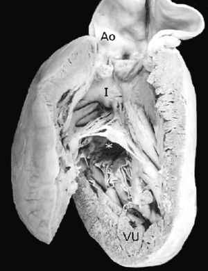 Vista interna de un corazón univentricular indeterminado. Obsérvese la porción de entrada representada por la válvula auriculoventricular común (asterisco) y por encima de esta la única vía de salida o infundíbulo del que emerge un tronco aórtico solitario. Ao: aorta; I: infundíbulo; VU: ventrículo único.