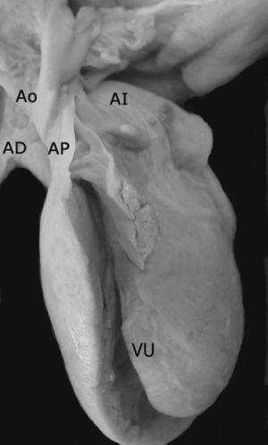 Vista externa anterior de un corazón en situs solitus auricular con doble entrada en ventrículo único y anomalía de Ebstein de la válvula auriculoventricular común. Las grandes arterias están normalmente relacionadas y emergen del ventrículo único. Obsérvese la porción funcional del ventrículo único ubicada en la zona trabecular anterior y en las zonas subinfundibular e infundibular. AD: aurícula derecha; Ao: aorta; AI: aurícula izquierda; AP: arteria pulmonar; VU: ventrículo único.
