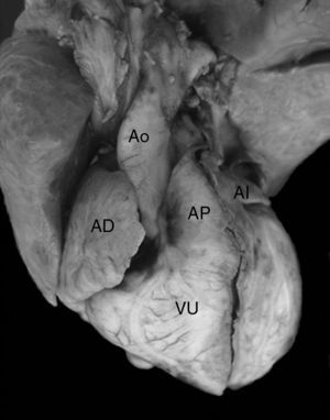 Vista externa frontal de un corazón en situs solitus auricular con ventrículo único que muestra la emergencia de las grandes arterias normalmente relacionadas a partir de esta cámara. AD: aurícula derecha; AI: aurícula izquierda; FP: foramen primum; VU: ventrículo único.