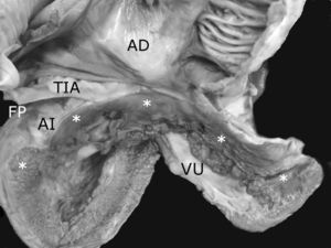 Vista interna posterior del corazón de la figura 7 que muestra las aurículas en situs solitus conectadas con el ventrículo único a través de una válvula auriculoventricular común. Obsérvese el adosamiento valvar a la pared del ventrículo único en su porción proximal (asteriscos) y la presencia de nodulaciones fibromixoides en su porción distal libre. La porción adosada corresponde a la zona auricularizada y el resto a la porción funcional del ventrículo único. AD: aurícula derecha; AI: aurícula izquierda; FP: foramen primum; TIA: tabique interauricular; VU: ventrículo único..