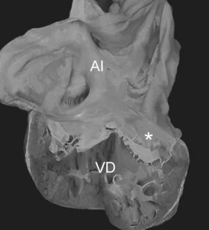 Vista interna de las cámaras cardíacas de un corazón con discordancia auriculoventricular y anomalía de Ebstein de la válvula tricúspide. Obsérvese la conexión de la aurícula izquierda con el ventrículo derecho, el adosamiento de la valva septal de la válvula tricúspide (asterisco). AI: aurícula izquierda; VD: ventrículo derecho.