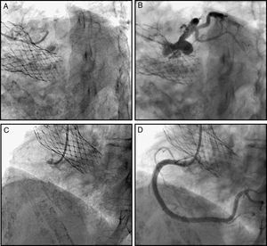 Coronary angiography with a CoreValve® implanted. Note the catheters passing through the prosthetic struts into the sinuses of Valsalva and into the coronary ostia, for a selective engagement (A, B) pre and post angiography of the left coronary artery in antero-posterior caudal view. (C, D) Pre and post angiography of the right coronary in left anterior oblique view.