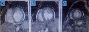 Resonancia magnética cardíaca. Diagnóstico de miocardio no compacto por relación miocardio no compacto/compacto de 2.4 medido en eje corto a nivel basal (A), medio (B) y apical (C)