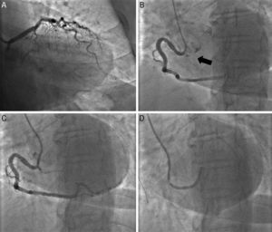 (A, B) Baseline coronary angiography. The arrow indicates the anomalous origin of a chronically occluded left circumflex artery. (C) Percutaneous coronary intervention with the chronic total occlusion successfully crossed. (D) Synergy® stent implanted.