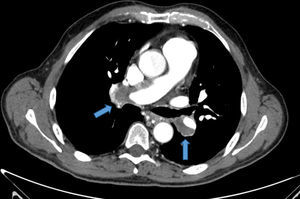 Angio-TC torácica, en la que se aprecian defectos de repleción en ambas arterias pulmonares principales, compatible con tromboembolismo pulmonar.