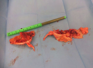 Pieza quirúrgica de la enfermedad pulmonar tromboembólica crónica.