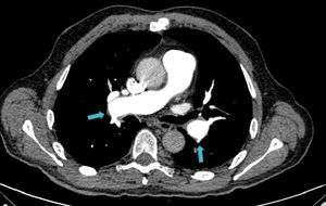 Angio-TC torácica tras la cirugía, en la que se aprecia repermeabilización endovascular en ambas arterias pulmonares principales.