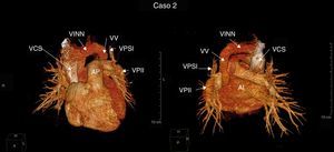 Caso 2: imágenes anterior y posterior de conexión anómala parcial de venas pulmonares izquierdas supracardiaca a vena vertical. AI: aurícula izquierda; AP: arteria pulmonar; VCS: vena cava superior; VINN: vena innominada; VPII: vena pulmonar inferior izquierda; VPSI: vena pulmonar superior izquierda; VV: vena vertical.