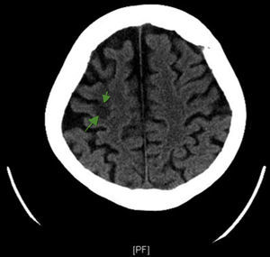 La tomografía computarizada craneal. Se objetivó un área hipodensa parietal derecha sugestiva de ictus isquémico (flecha).