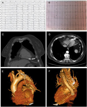 A) Electrocardiograma tras el implante en sala de electrofisiología. B) Electrocardiograma tras la perforación cardiaca. C y D) TC torácica. Electrodo perforando la pared miocárdica penetrando en grasa paracardiaca. E y F) Reconstrucción tridimensional donde se visualiza punta de electrodo traspasando miocardio de pared anterior de VD.