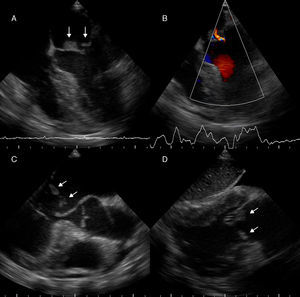 Ecocardiograma transesofágico. A y B. Vista medio esofágica de 4 cámaras (modificada), en las que se observan imágenes ecogénicas en la superficie auricular de ambas valvas de la válvula mitral, de gran tamaño, de bordes irregulares, sésiles, en festones A2 y P2 (flechas), que con doppler color permite observar insuficiencia valvular leve. C. Vista medio esofágica de eje largo de la válvula aórtica (modificada), donde se observan ambas vegetaciones adosadas a la superficie auricular de las valvas de la válvula mitral (flechas). D. Vista transgástrica de 2 cámaras. Se observan vegetaciones en la superficie auricular de las valvas de la válvula mitral (flechas).