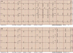 A) Electrocardiograma basal con bloqueo completo de rama izquierda del haz de His. B) Electrocardiograma sin bloqueo de rama izquierda, con ondas T negativas de V1 a V4 compatibles con fenómeno de memoria eléctrica.